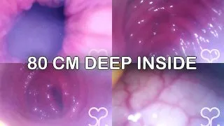 Anal Endoscope all the way in my Transverse Colon - Full Video on Manyvids and Fansly